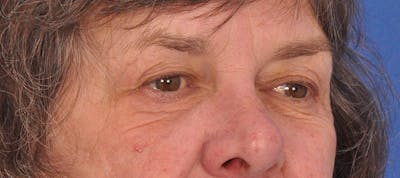 Blepharoplasty Before & After Gallery - Patient 110122 - Image 1