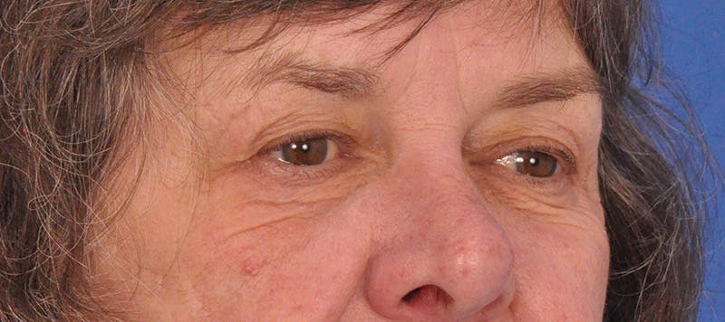 Blepharoplasty Before & After Gallery - Patient 110122 - Image 1