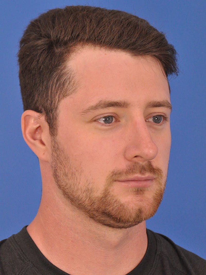 Chin Filler Before & After Gallery - Patient 228531 - Image 3