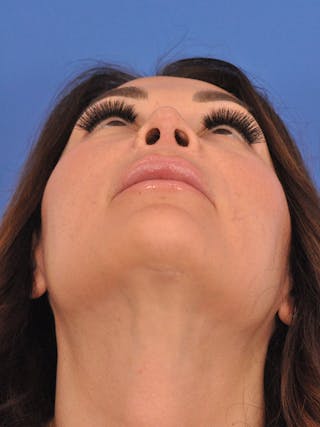 Rhinoplasty Before & After Gallery - Patient 386262 - Image 8