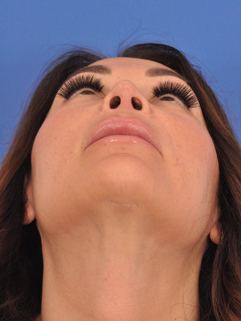 Rhinoplasty Before & After Gallery - Patient 386262 - Image 8