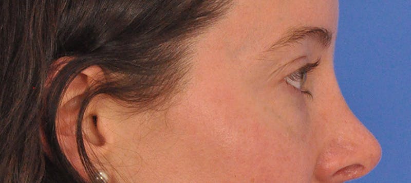 Tear Trough Filler Before & After Gallery - Patient 265185 - Image 7