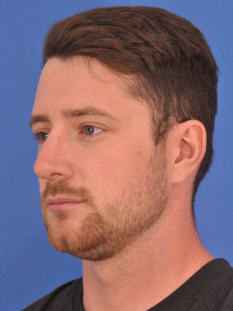 Chin Filler Before & After Gallery - Patient 228531 - Image 7