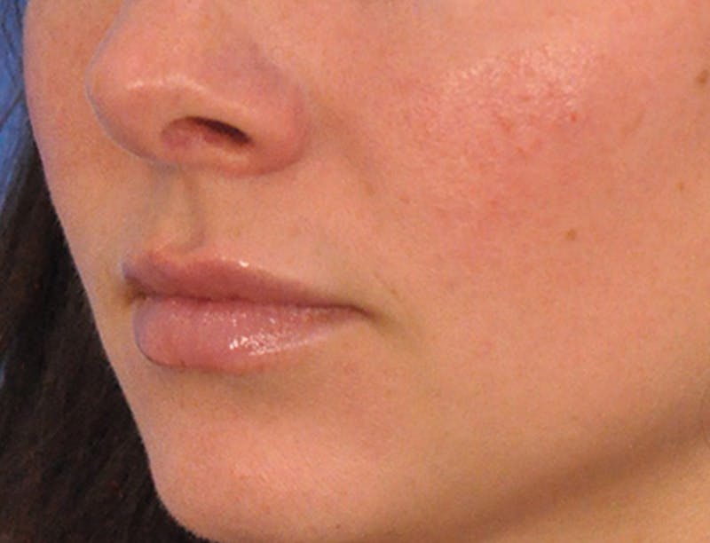 Lip Filler Before & After Gallery - Patient 829353 - Image 10