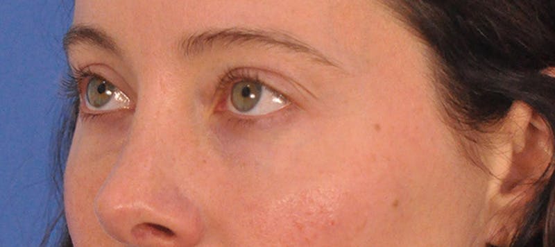 Tear Trough Filler Before & After Gallery - Patient 265185 - Image 10