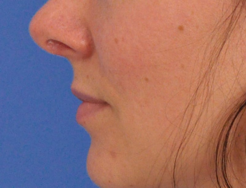 Lip Filler Before & After Gallery - Patient 829353 - Image 11