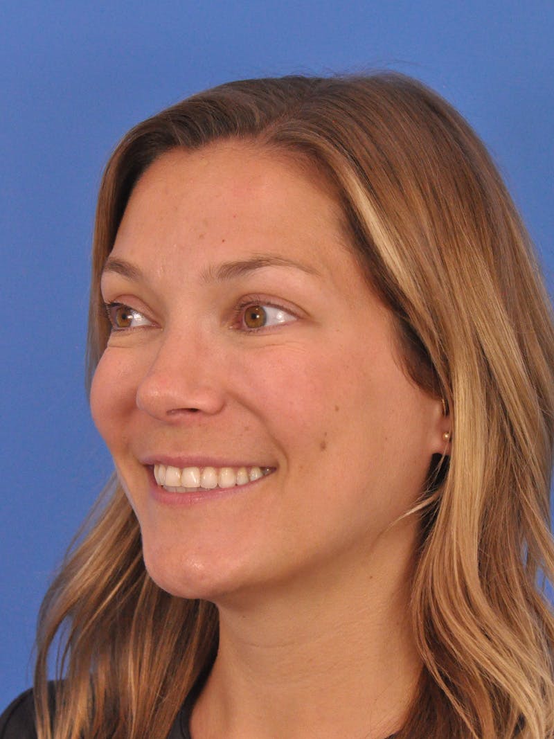 Cheek Filler Before & After Gallery - Patient 187973 - Image 14