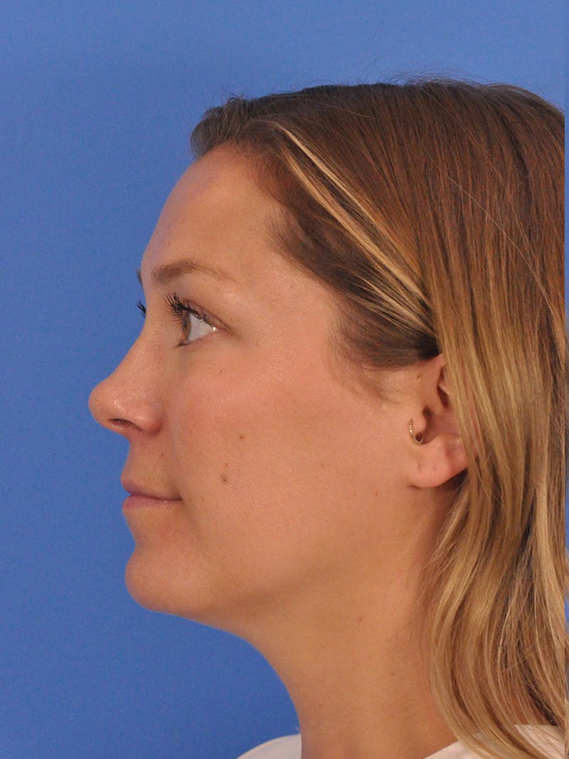 Cheek Filler Before & After Gallery - Patient 187973 - Image 15