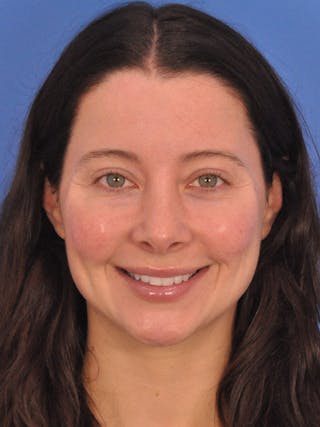 Cheek Filler Before & After Gallery - Patient 385411 - Image 4