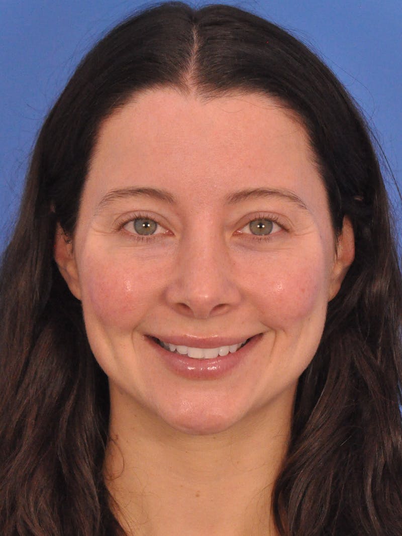 Cheek Filler Before & After Gallery - Patient 385411 - Image 4