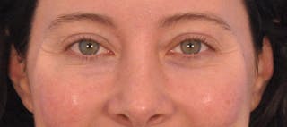 Tear Trough Filler Before & After Gallery - Patient 265185 - Image 2