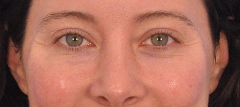 Tear Trough Filler Before & After Gallery - Patient 265185 - Image 2