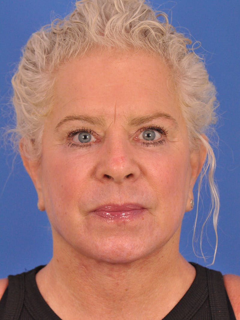 Neck Lift Before & After Gallery - Patient 563465 - Image 6