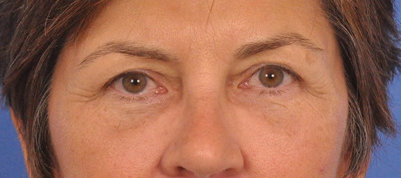 Blepharoplasty Before & After Gallery - Patient 358961 - Image 4