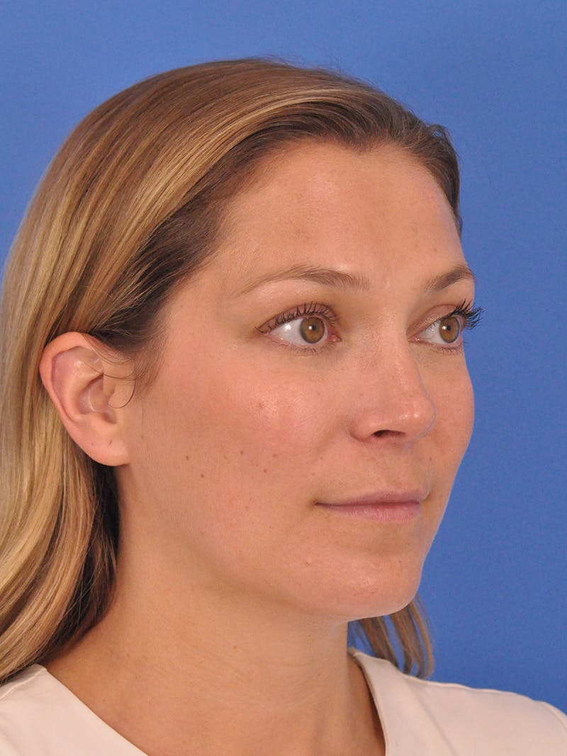 Cheek Filler Before & After Gallery - Patient 187973 - Image 5