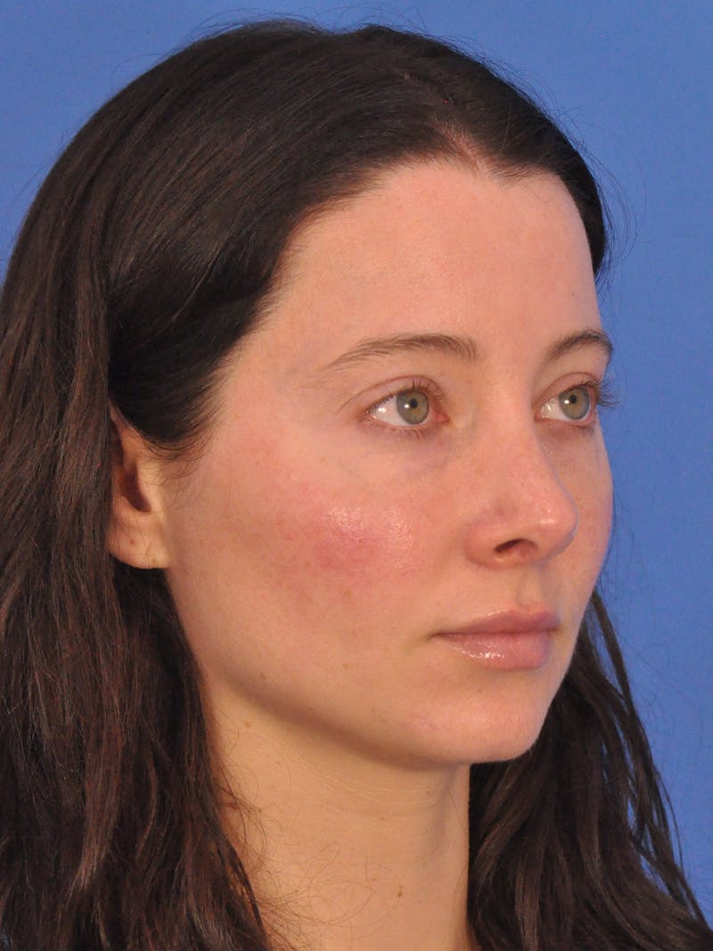 Cheek Filler Before & After Gallery - Patient 385411 - Image 6