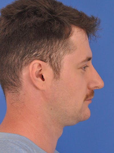 Chin Filler Before & After Gallery - Patient 228531 - Image 2