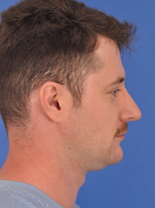 Chin Filler Before & After Gallery - Patient 228531 - Image 2