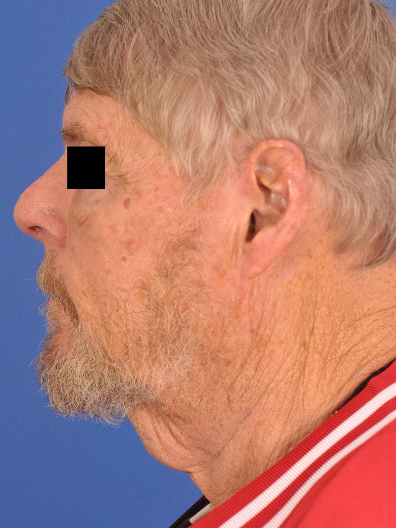 Neck Lift Before & After Gallery - Patient 891184 - Image 9