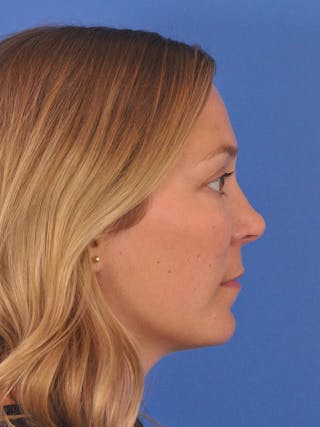 Cheek Filler Before & After Gallery - Patient 187973 - Image 10