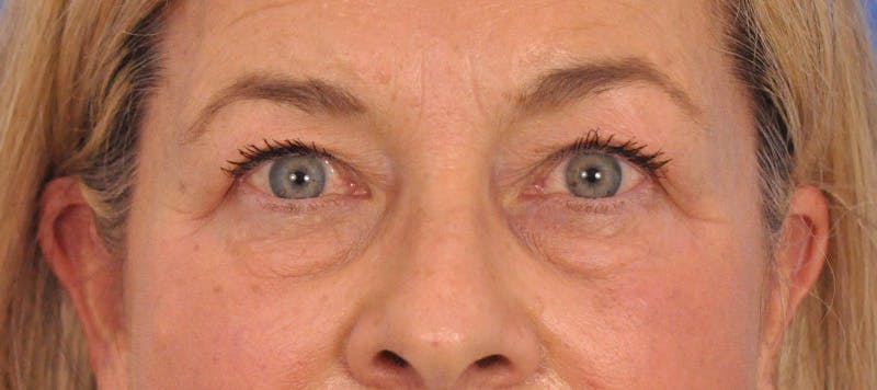 CO2RE Laser Before & After Gallery - Patient 140276 - Image 1