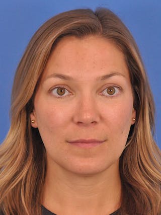 Cheek Filler Before & After Gallery - Patient 187973 - Image 2