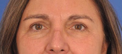 Blepharoplasty Before & After Gallery - Patient 761684 - Image 2