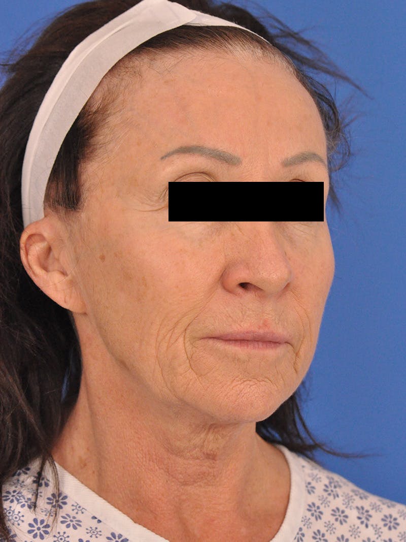 Neck Lift Before & After Gallery - Patient 128768 - Image 3