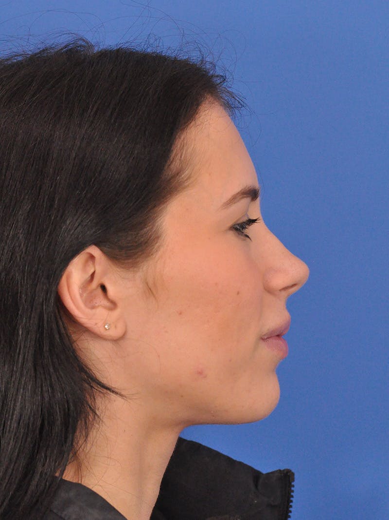 Rhinoplasty Before & After Gallery - Patient 405044 - Image 1