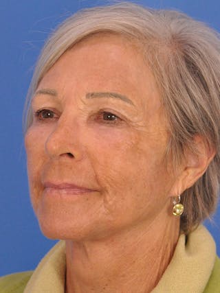 Blepharoplasty Before & After Gallery - Patient 341741 - Image 8