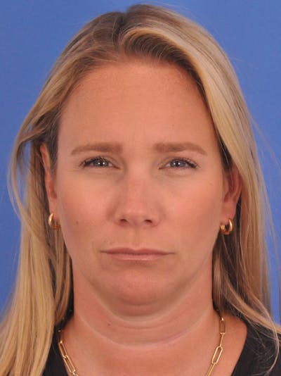 BOTOX Before & After Gallery - Patient 749775 - Image 2
