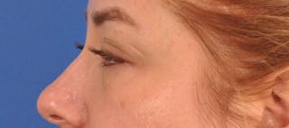 Blepharoplasty Before & After Gallery - Patient 391503 - Image 12