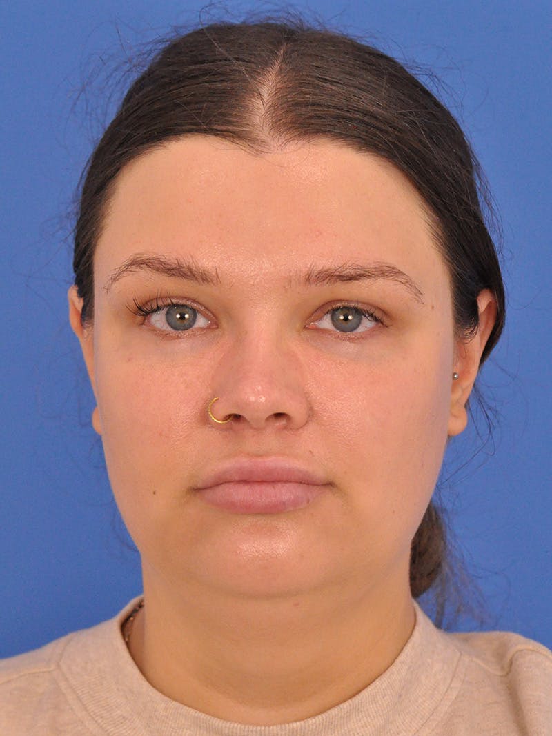 Chin Augmentation Before & After Gallery - Patient 174515 - Image 5