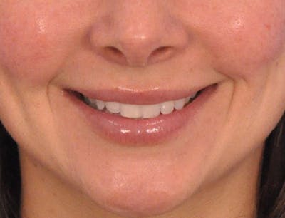 Lip Filler Before & After Gallery - Patient 829353 - Image 2