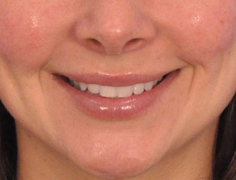 Lip Filler Before & After Gallery - Patient 829353 - Image 2