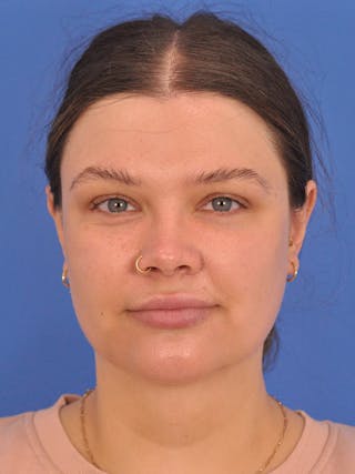 Chin Augmentation Before & After Gallery - Patient 174515 - Image 6