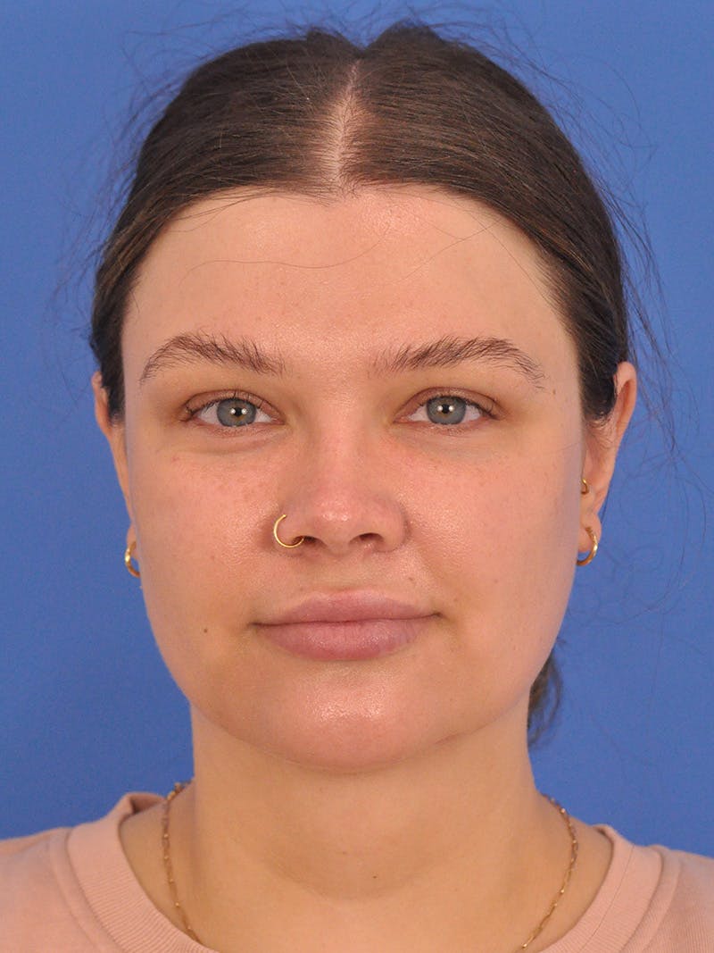 Chin Augmentation Before & After Gallery - Patient 174515 - Image 6