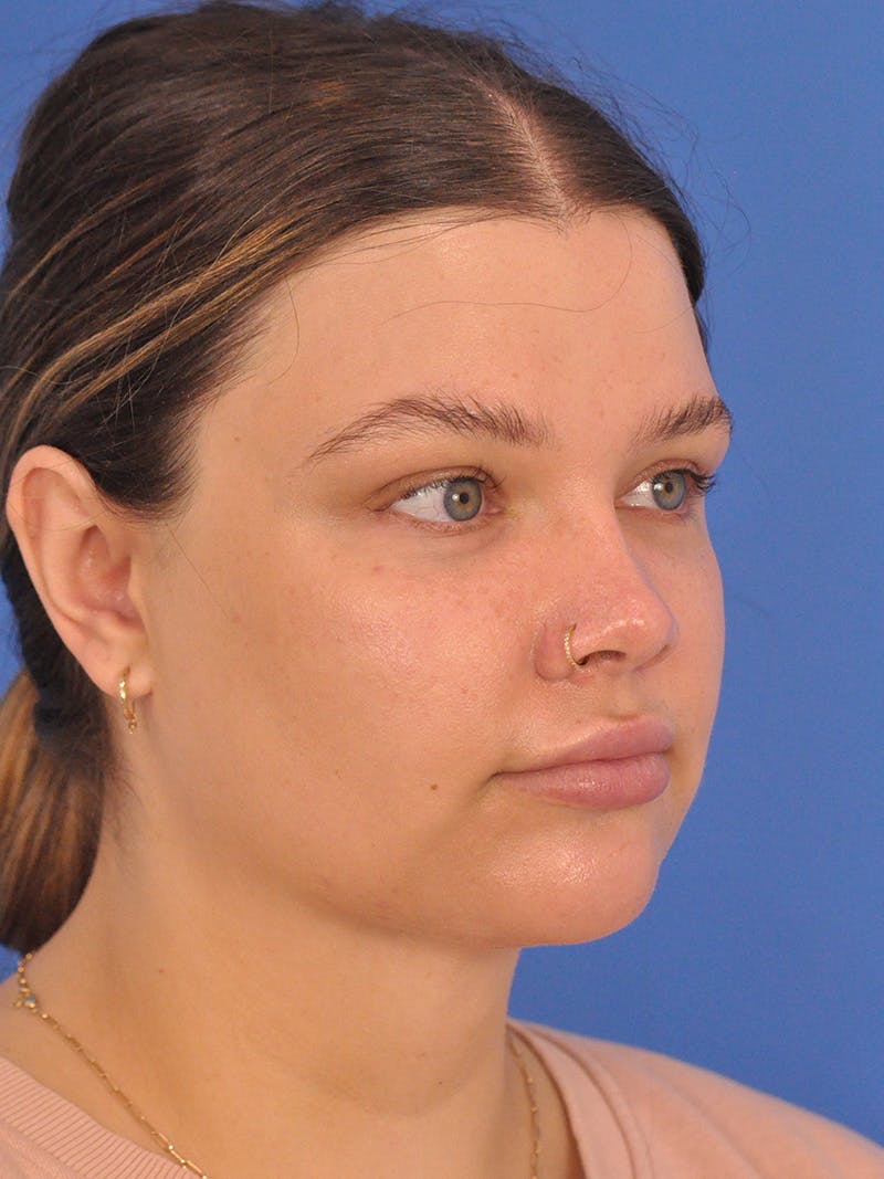 Chin Augmentation Before & After Gallery - Patient 174515 - Image 4