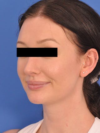 Rhinoplasty Before & After Gallery - Patient 368634 - Image 6