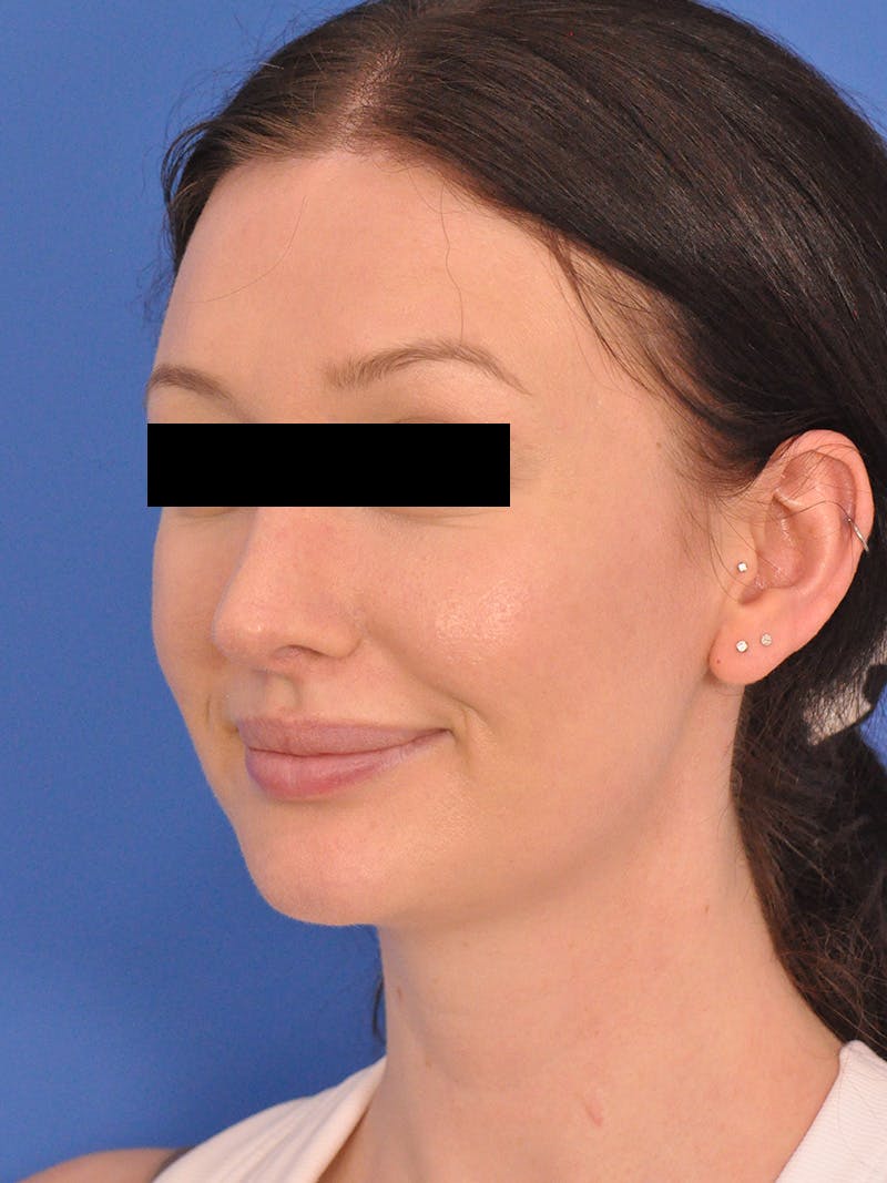 Rhinoplasty Before & After Gallery - Patient 368634 - Image 6