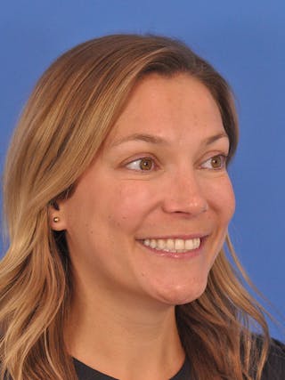 Cheek Filler Before & After Gallery - Patient 187973 - Image 8