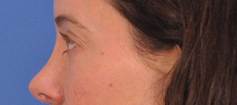 Tear Trough Filler Before & After Gallery - Patient 265185 - Image 12