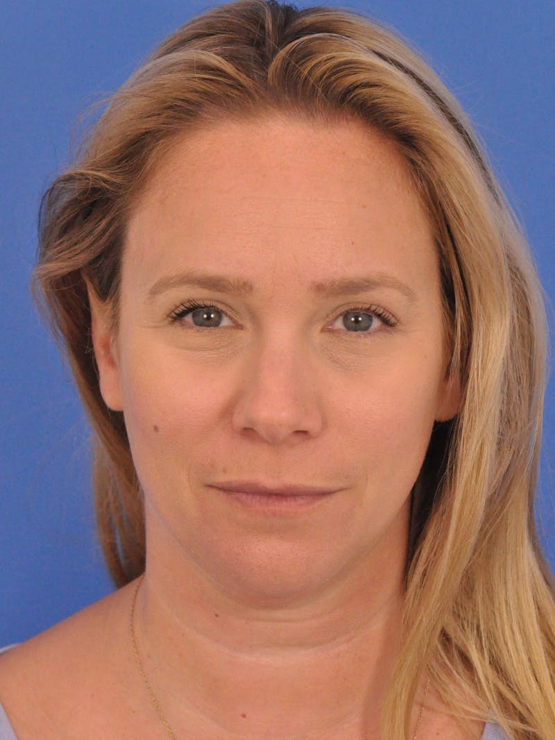 BOTOX Before & After Gallery - Patient 749775 - Image 3