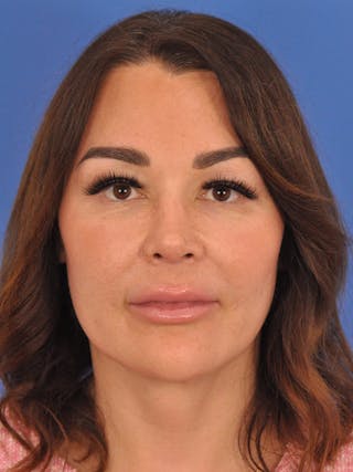 Rhinoplasty Before & After Gallery - Patient 386262 - Image 6