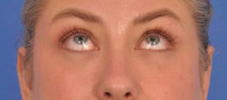Blepharoplasty Before & After Gallery - Patient 391503 - Image 4