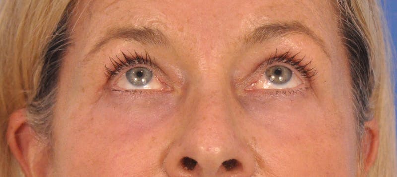 CO2RE Laser Before & After Gallery - Patient 140276 - Image 4