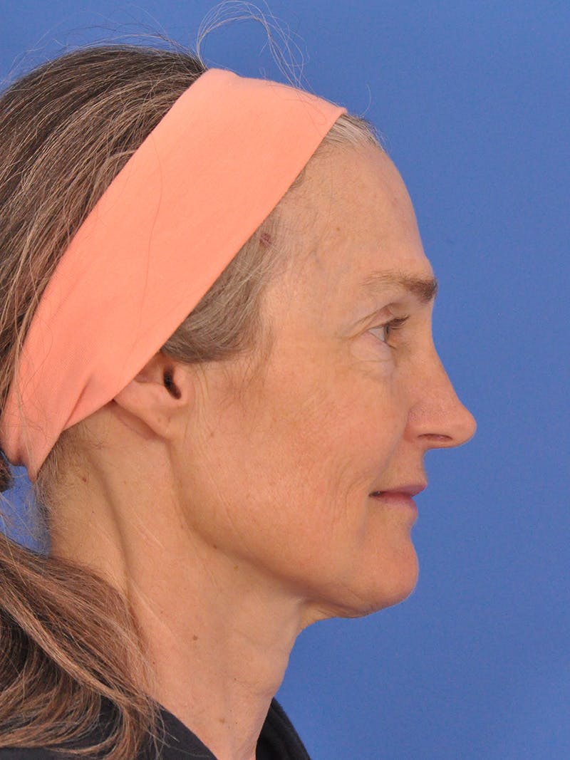 Vbeam Laser Before & After Gallery - Patient 348841 - Image 6