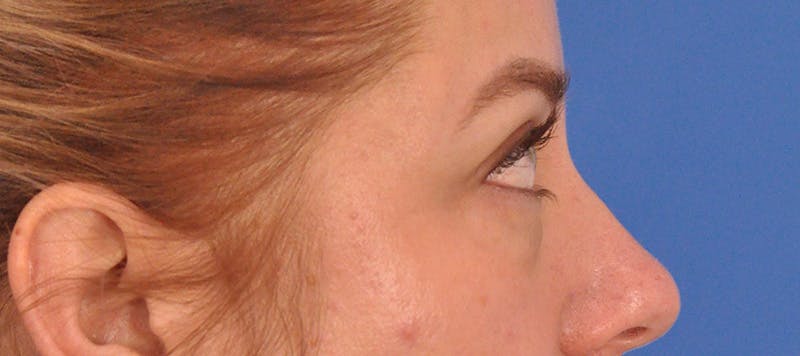 Blepharoplasty Before & After Gallery - Patient 391503 - Image 8