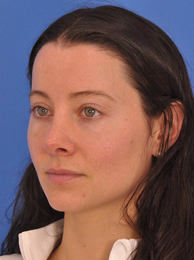 Cheek Filler Before & After Gallery - Patient 385411 - Image 9