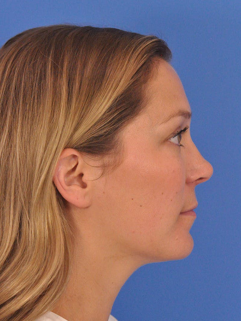 Cheek Filler Before & After Gallery - Patient 187973 - Image 9